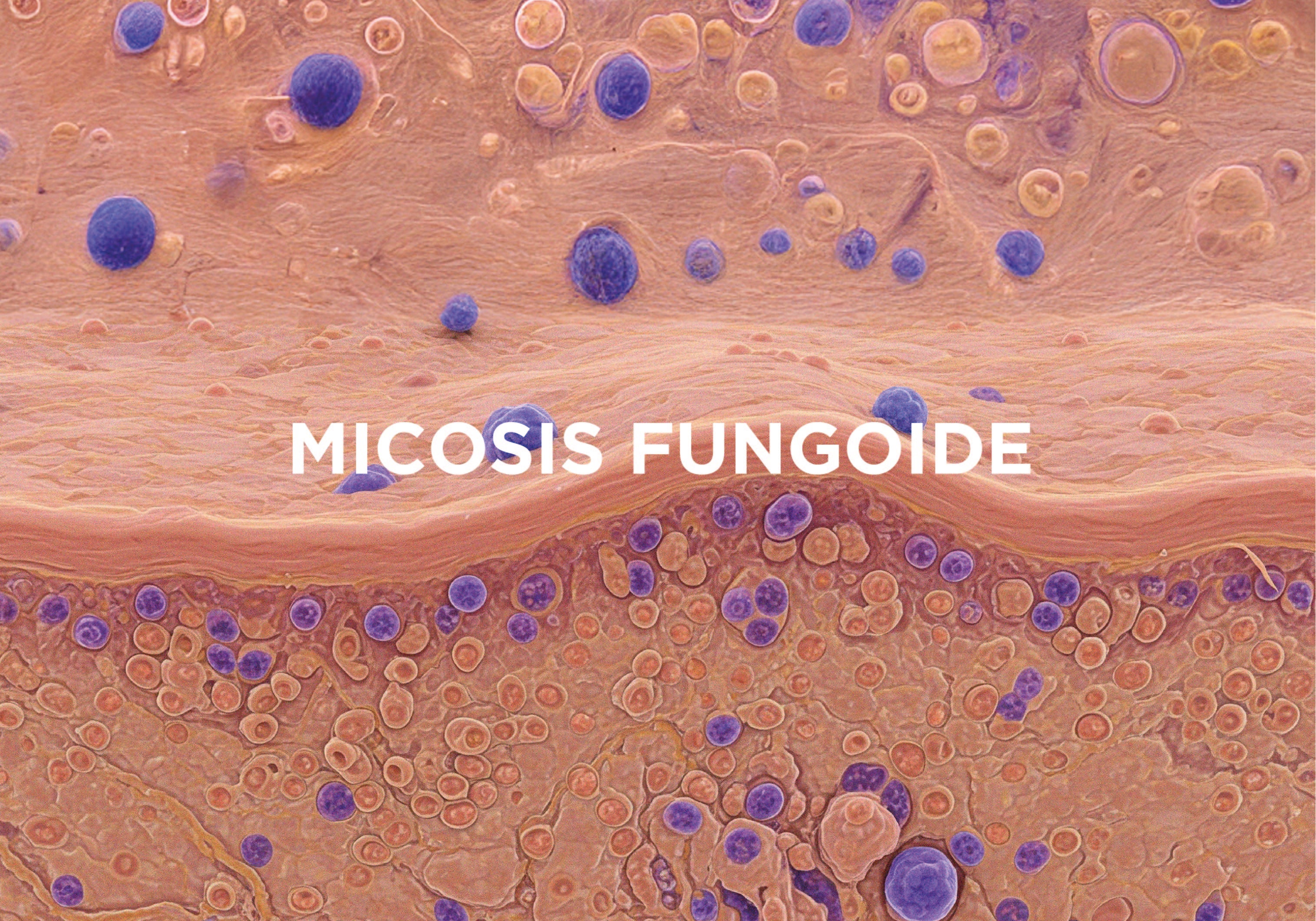 micosis fungoide