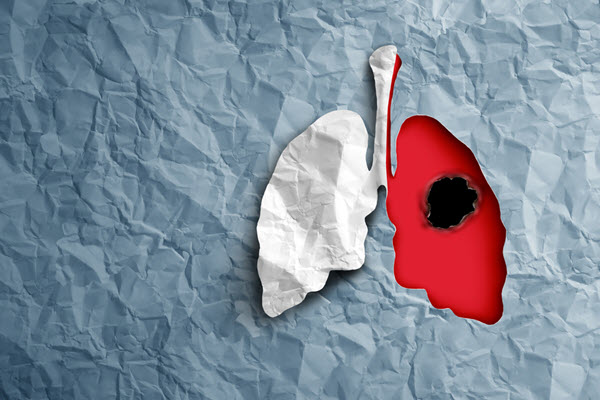 El cáncer de pulmón es uno de los tipos de cáncer más frecuentes