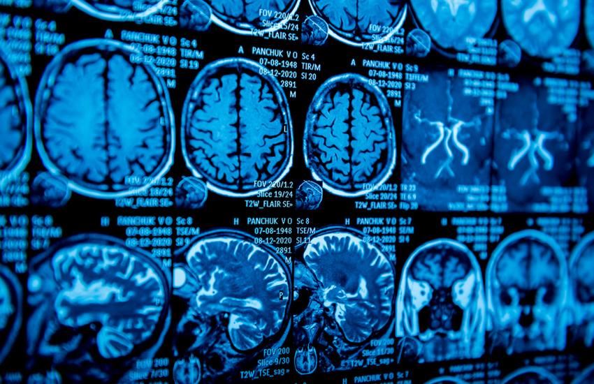 LAS METÁSTASIS CEREBRALES