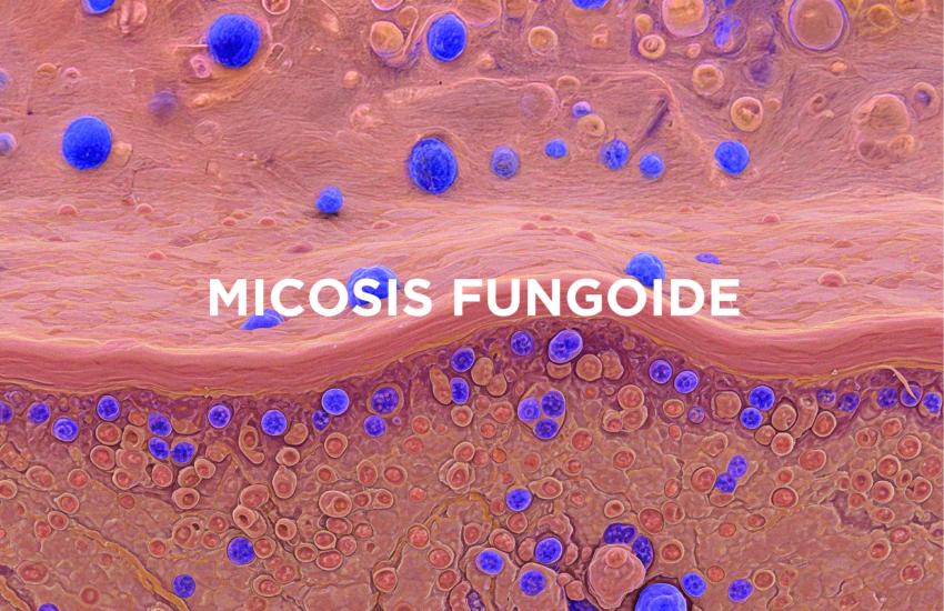 micosis fungoide