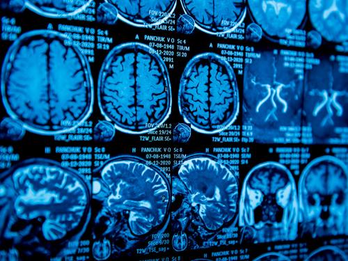 LAS METÁSTASIS CEREBRALES