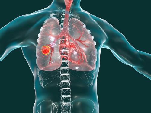 XIII Jornada de Revisión del Congreso Mundial de Cáncer de Pulmón, WCLC 2022