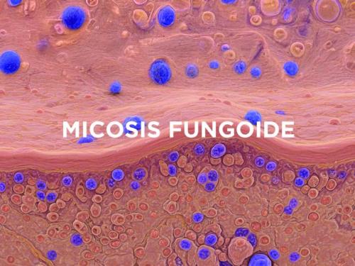 micosis fungoide