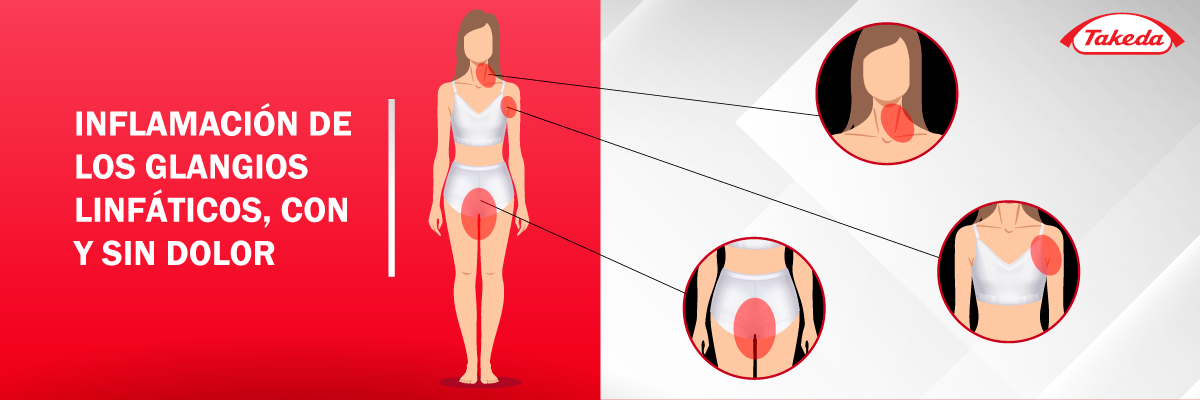 Inflamación de los ganglios linfáticos, con y sin dolor.